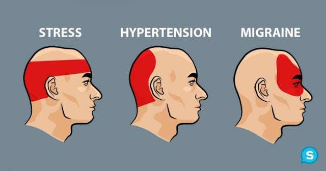 Cara Mengusir Sakit Kepala Dalam 5 Menit
